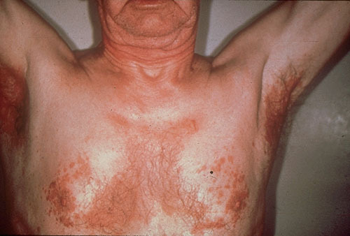 Fibrofolliculoma diagnosis | Fibrofolliculoma.info